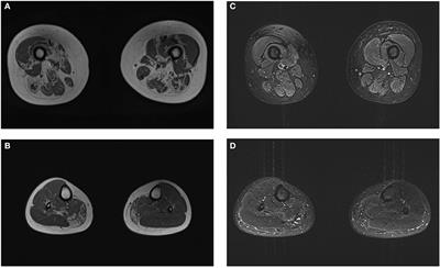 Frameshift mutation in SQSTM1 causes proximal myopathy with rimmed vacuoles: A case report